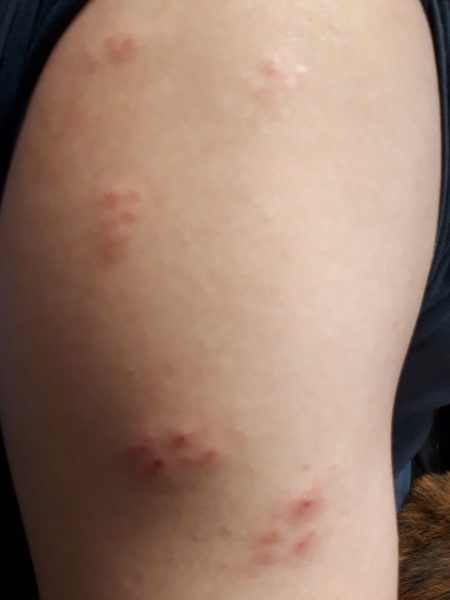 何か治りにくい?そして増える発疹=帯状疱疹!?年齢関係無くご注意を