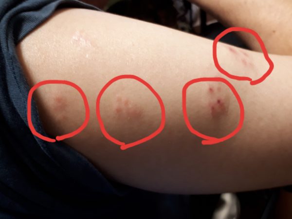 何か治りにくい?そして増える発疹=帯状疱疹!?年齢関係無くご注意を