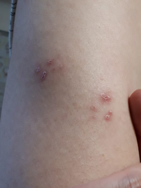 何か治りにくい?そして増える発疹=帯状疱疹!?年齢関係無くご注意を